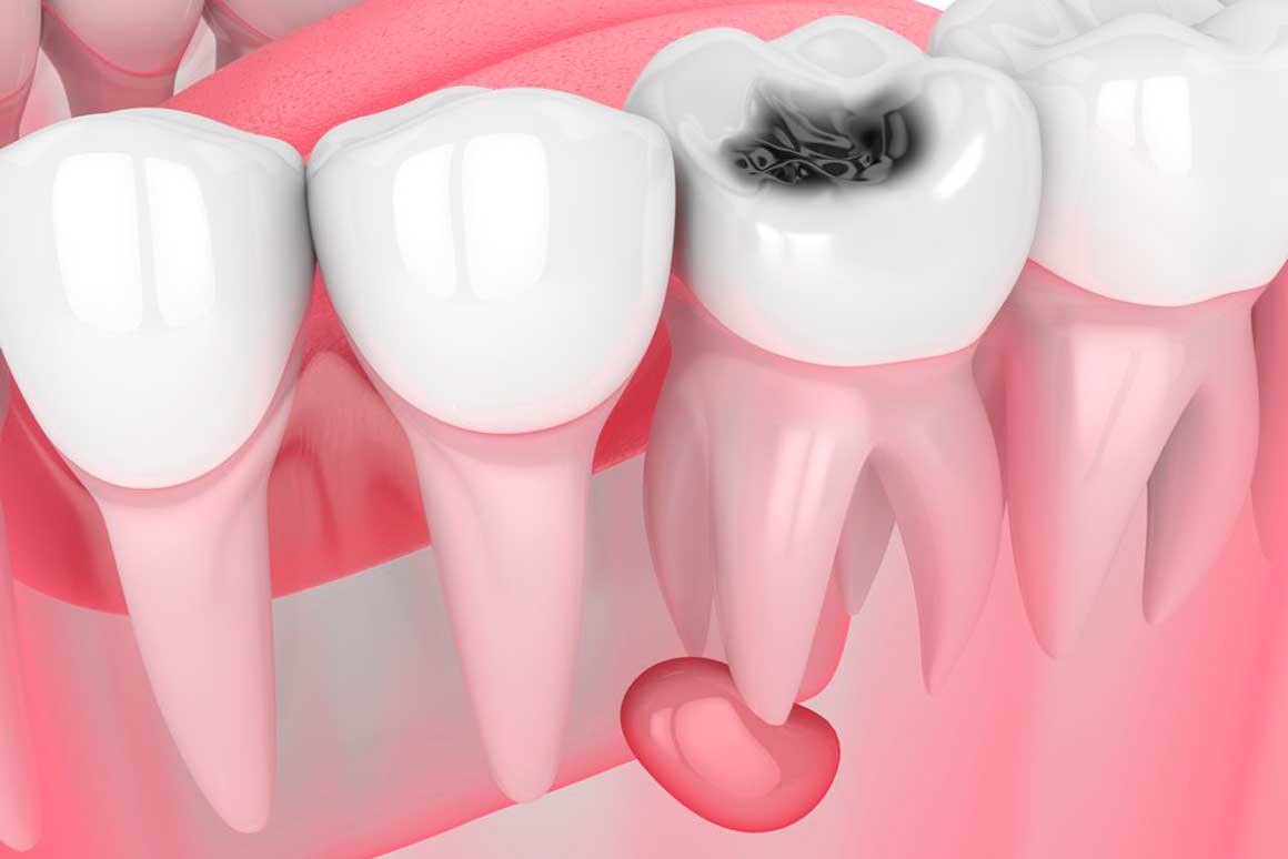 Особенности лечения кисты зуба